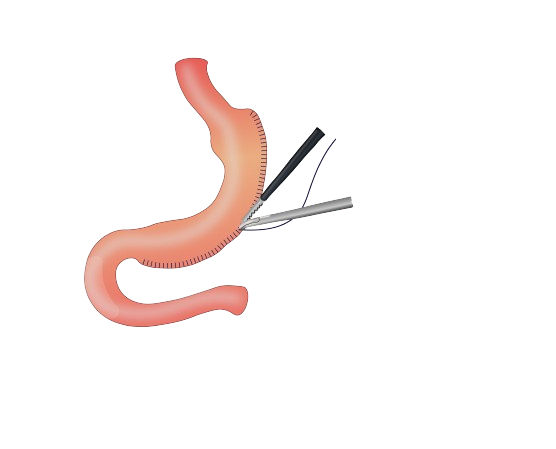 dv_laparoscopia_01